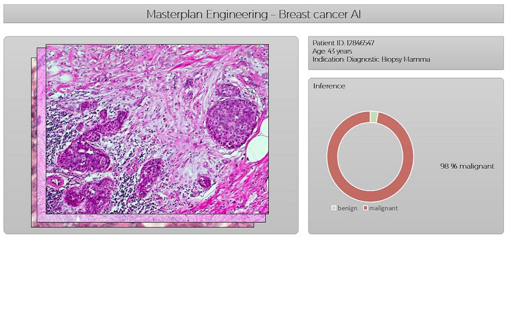 Breast cancer AI